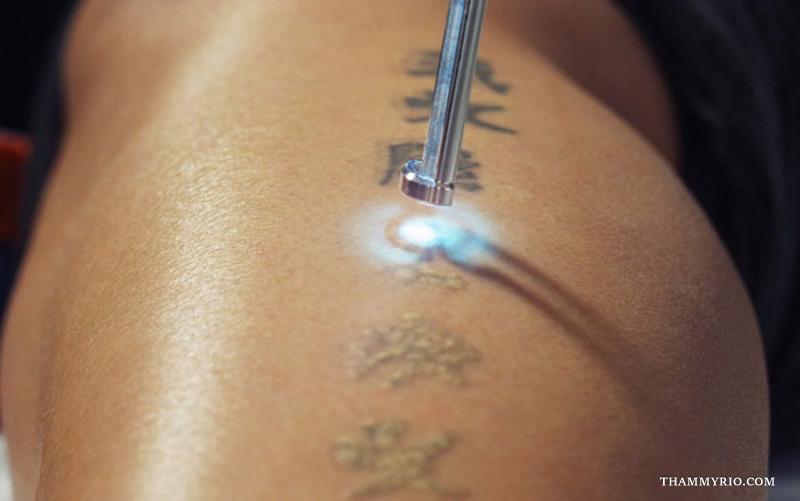Hình ảnh sau khi xóa xăm bằng công nghệ Laser hiện đại 11 Hình ảnh phương pháp đốt xăm loại bỏ hình xăm chữ trên da