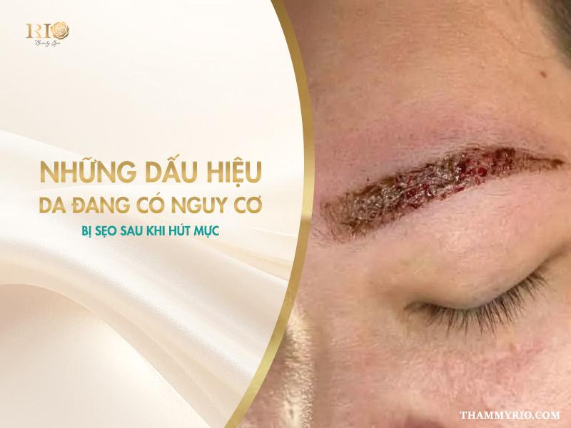 Xóa chân mày có để lại sẹo không? Sự thật mà ít ai biết 6 Những dấu hiệu da có nguy cơ bị sẹo sau khi hút mực – Giải đáp xóa chân mày có để lại sẹo không