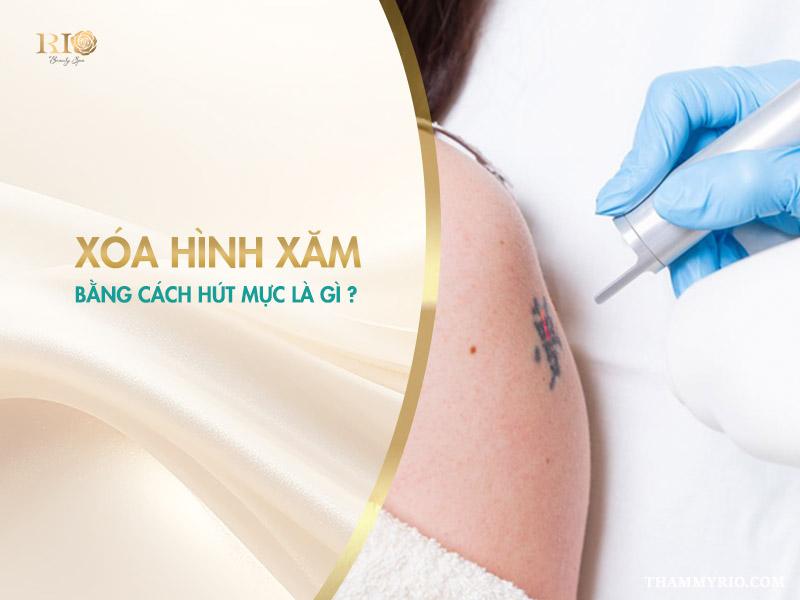 Xóa hình xăm bằng cách hút mực: Giải pháp, Lưu ý quan trọng 2 Xóa hình xăm bằng cách hút mực là cách gọi phổ thông để chỉ chung các kỹ thuật nhằm loại bỏ các hạt mực xăm đã được đưa vào sâu bên trong lớp trung bì của da.