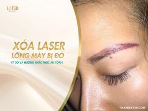 Cảm giác hoang mang khi thấy vùng da chân mày ửng đỏ sau buổi xóa xăm Laser là một tâm lý hoàn toàn dễ hiểu. Liệu đây có phải là dấu hiệu của một biến chứng đáng ngại? Hiện tượng xoá laser lông mày bị đỏ sẽ kéo dài bao lâu và làm thế nào để xử lý triệt để?
