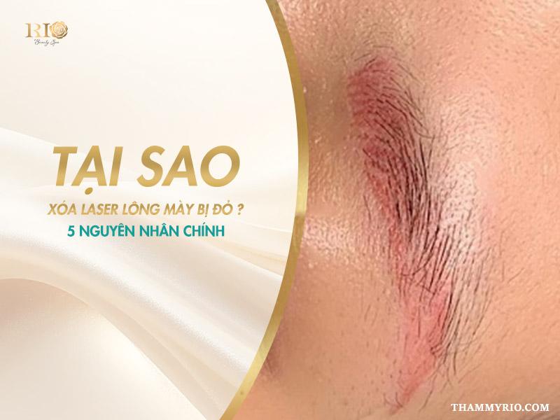 Xóa laser lông mày bị đỏ: Lý do và hướng khắc phục an toàn 2 Tình trạng da ửng đỏ sau khi xóa Laser không phải là hiếm. Hãy cùng tìm hiểu 5 nguyên nhân chính khiến sau khi xóa Laser lông mày bị đỏ.