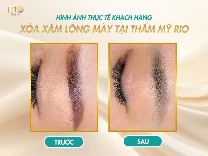 Xóa laser lông mày bị đỏ: Lý do và hướng khắc phục an toàn 7 Hình ảnh thực tế khách hàng xóa xăm lông mày tại Thẩm Mỹ Rio Beauty Clinic