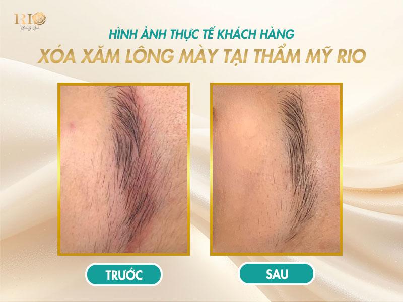 Xóa laser lông mày bị đỏ: Lý do và hướng khắc phục an toàn 8 Đây là hình ảnh thực tế Thẩm Mỹ Rio hạn chế tình trạng xóa Laser lông mày bị đỏ.