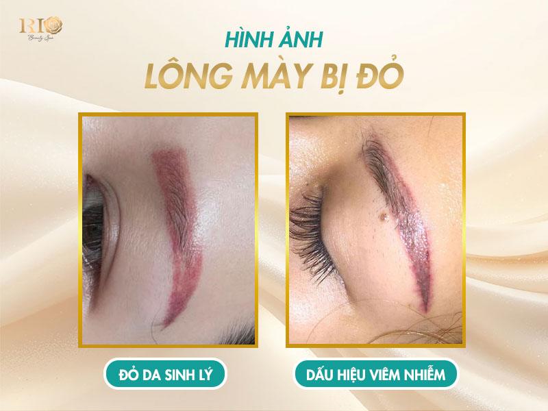Xóa laser lông mày bị đỏ: Lý do và hướng khắc phục an toàn 4 Hiểu rõ sự khác biệt giữa hai tình trạng xóa Laser lông mày bị đỏ là chìa khóa để chăm sóc đúng cách và ngăn ngừa những biến chứng không mong muốn.
