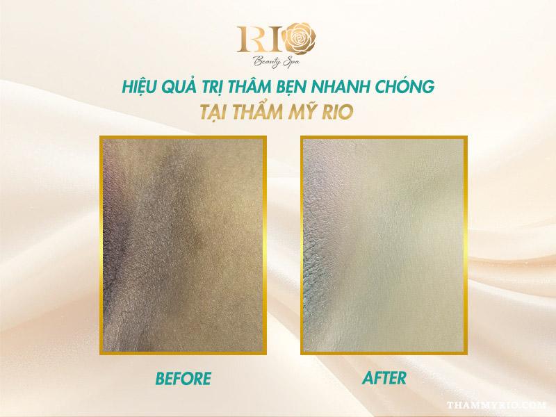 Cách trị thâm bẹn tại nhà có tốt không? Giải pháp thay thế 10 Kết quả trước và sau khi áp dụng cách trị thâm bẹn tại Thẩm Mỹ Rio