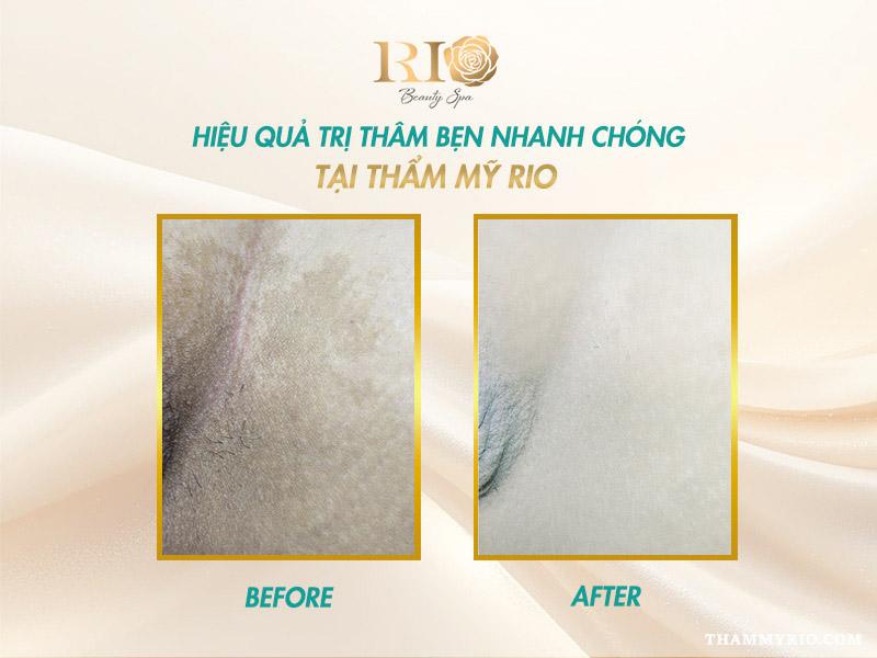 Cách trị thâm bẹn tại nhà có tốt không? Giải pháp thay thế 11 Hiệu quả trị thâm bẹn nhanh chóng, an toàn và lâu dài nhờ công nghệ thẩm mỹ hiện đại tại Rio Beauty Clinic.