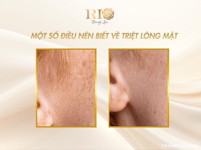 Có nên triệt lông mặt không? Giải mã chi tiết từ A-Z 3 Một số điều nên biết về triệt lông mặt
