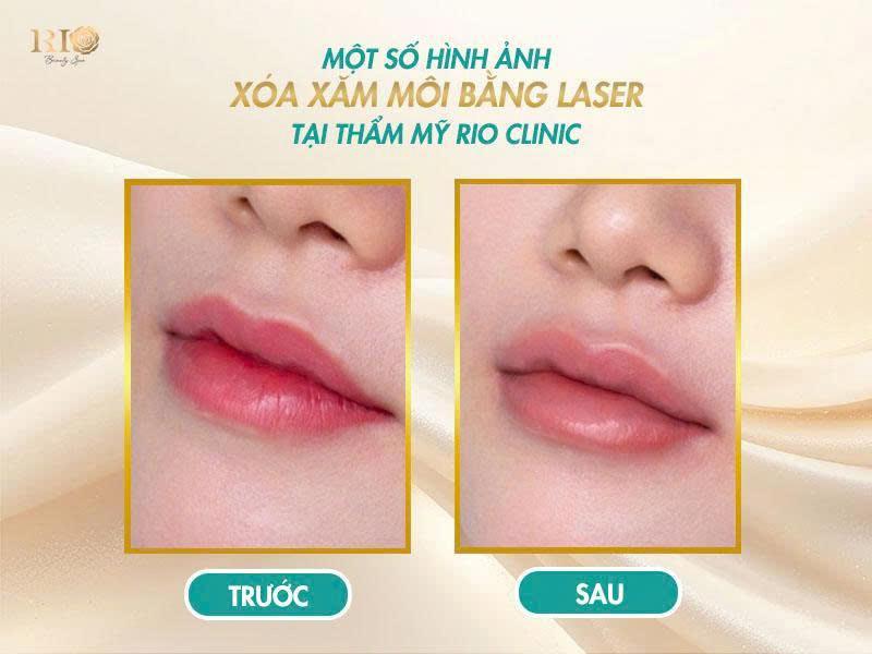 Nhận biết dấu hiệu phun môi thành công và không lên màu 7 Hình ảnh xóa xăm môi an toàn tại Rio khi kết quả không đạt dấu hiệu phun môi thành công.