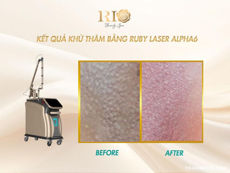 Công nghệ khử thâm vùng kín hiện đại với Ruby Laser Alpha6