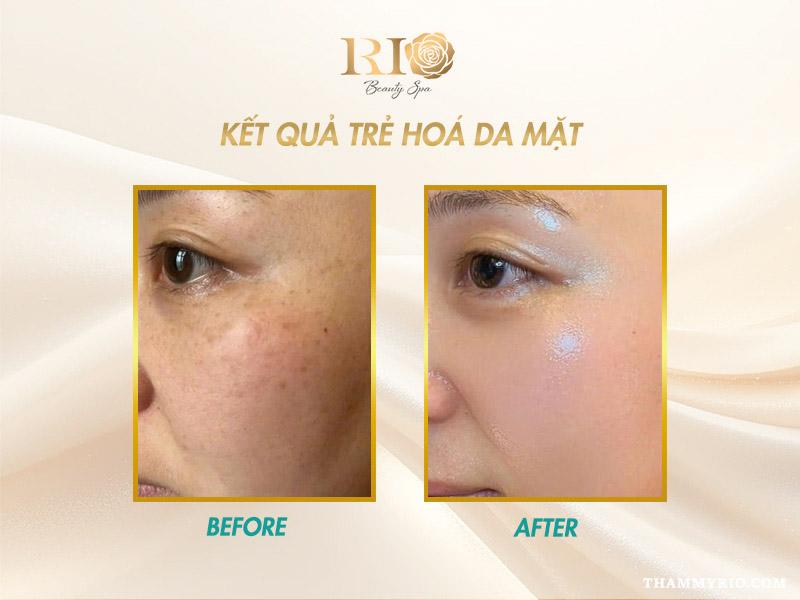 Máy Co2 Fractional Fotona 5D - Chuyên khử thâm và trẻ hóa da 8 Chuyên gia xóa tàn nhang và nốt ruồi an toàn nhanh chóng đó chính là máy Máy Fotona 5D an toàn Thẩm Mỹ Rio Beauty Clinic