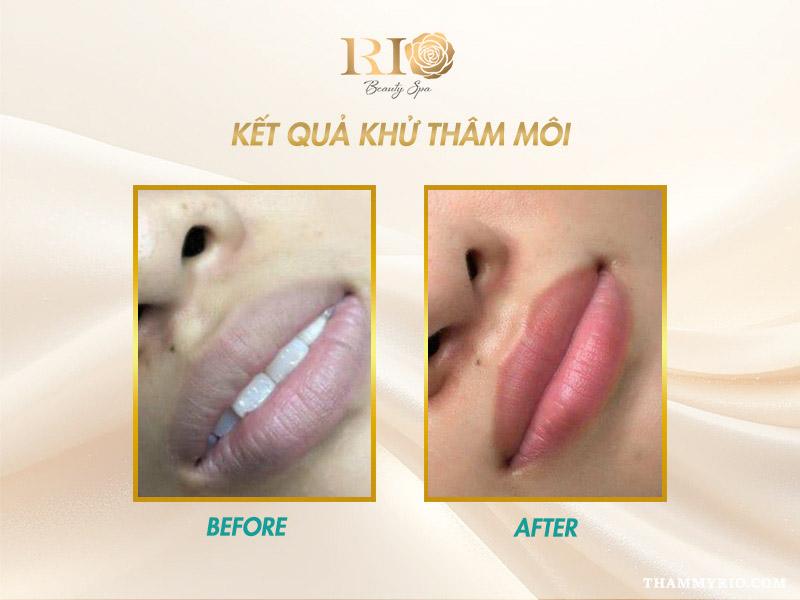 Máy Co2 Fractional Fotona 5D - Chuyên khử thâm và trẻ hóa da 13 Khử thâm môi bằng công nghệ laser Máy Co2 Fractional Fotona 5D