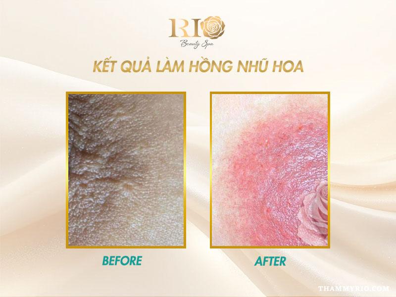 Máy Co2 Fractional Fotona 5D - Chuyên khử thâm và trẻ hóa da 10 Máy Co2 Fractional Fotona 5D khử thâm nhũ hoa đẹp