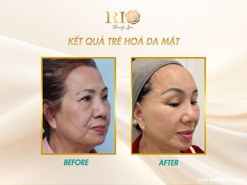 Máy Co2 Fractional Fotona 5D - Chuyên khử thâm và trẻ hóa da 9 Máy Co2 Fractional Fotona 5D cũng là dòng máy chuyên xóa nốt ruồi và thâm sạm ở mặt