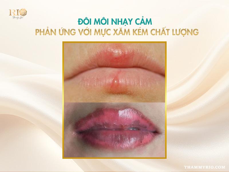 Khôn lường: Tác hại của phun môi tại cơ sở kém chất lượng 4 Dị ứng mực xăm và tác hại của phun môi