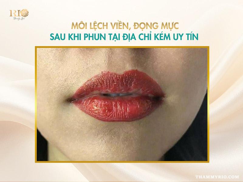 Khôn lường: Tác hại của phun môi tại cơ sở kém chất lượng 5 Môi lệch viền do tác hại của phun môi