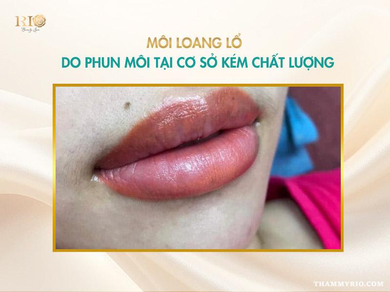 Khôn lường: Tác hại của phun môi tại cơ sở kém chất lượng 6 Môi loang lổ và tác hại của phun môi kém chất lượng