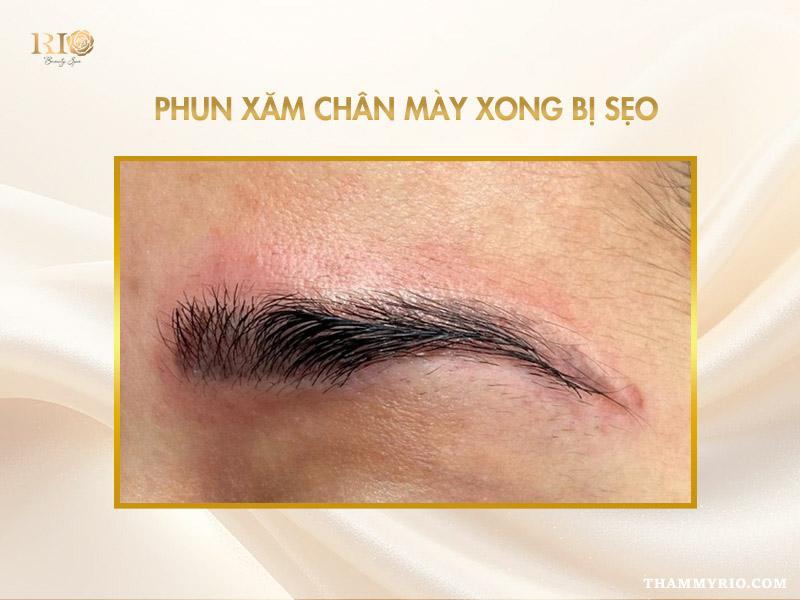 Tác hại của xăm chân mày - Có nên xăm chân mày không? 3 Sẹo để lại sau khi xăm chân mày sai kỹ thuật tại địa chỉ kém uy tín
