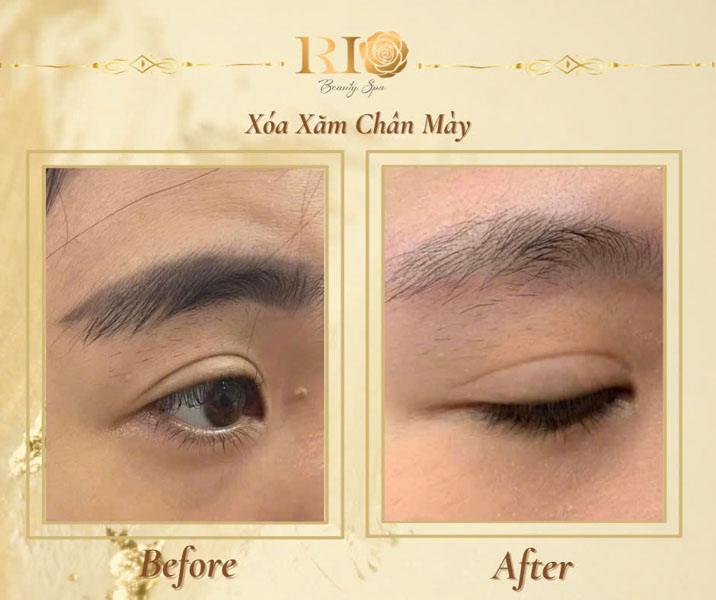 Tác hại của xăm chân mày - Có nên xăm chân mày không? 7 Kết quả xóa xăm lông mày bằng laser hiện đại an toàn