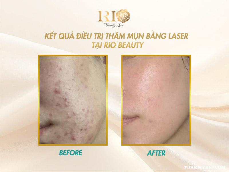 Trị thâm bằng laser có hiệu quả không? Ưu điểm và chi phí? 4 Kết quả trị thâm bằng laser trước và sau trên vùng má khách hàng