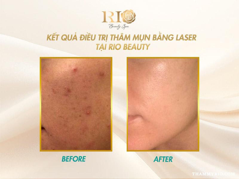 Trị thâm bằng laser có hiệu quả không? Ưu điểm và chi phí? 5 Hiệu quả trị thâm bằng laser giúp da đều màu, sạch thâm