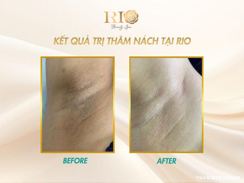 Bật mí những cách trị thâm nách hiệu quả, duy trì lâu dài 7 Hình ảnh trước và sau khi trị thâm nách bằng Laser tại Thẩm Mỹ Rio