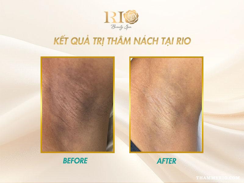 Bật mí những cách trị thâm nách hiệu quả, duy trì lâu dài 8 Hình ảnh so sánh trước và sau trị thâm nách tại Thẩm Mỹ Rio