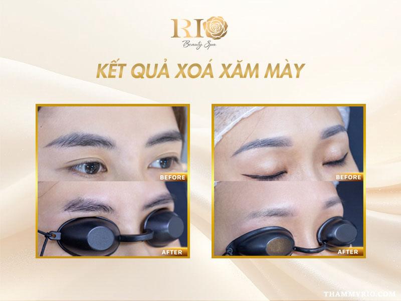 Nguyên nhân xăm chân mày lỗi và hướng khắc phục hiệu quả 10 Hình ảnh xóa xăm chân mày lỗi bằng công nghệ hiện đại tại Rio.