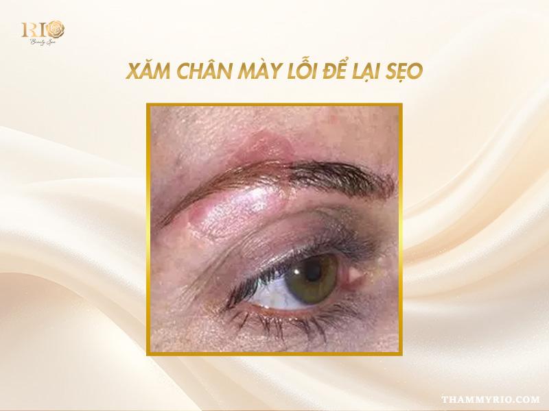 Nguyên nhân xăm chân mày lỗi và hướng khắc phục hiệu quả 4 Xăm chân mày lỗi để lại sẹo gây mất thẩm mỹ khuôn mặt.