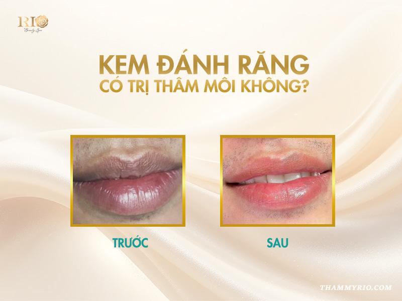 5 cách làm môi hết thâm bằng kem đánh răng tại nhà nên thử 3 Kem đánh răng có trị thâm môi không?