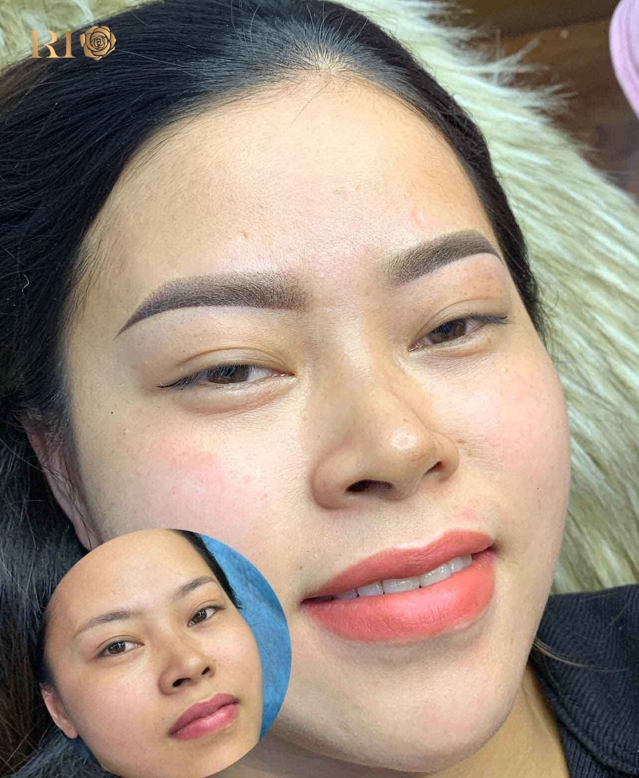 Khử thâm môi cho khách hàng bị thâm môi cơ địa