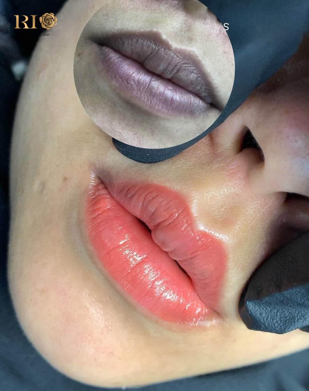 Môi sau khi làm xong khoảng 1 tuần