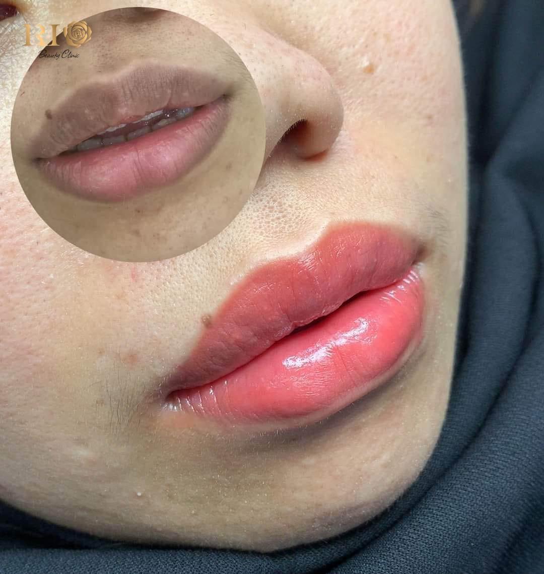 Phun xăm môi kết hợp khử thâm môi bằng mực xăm của Đức