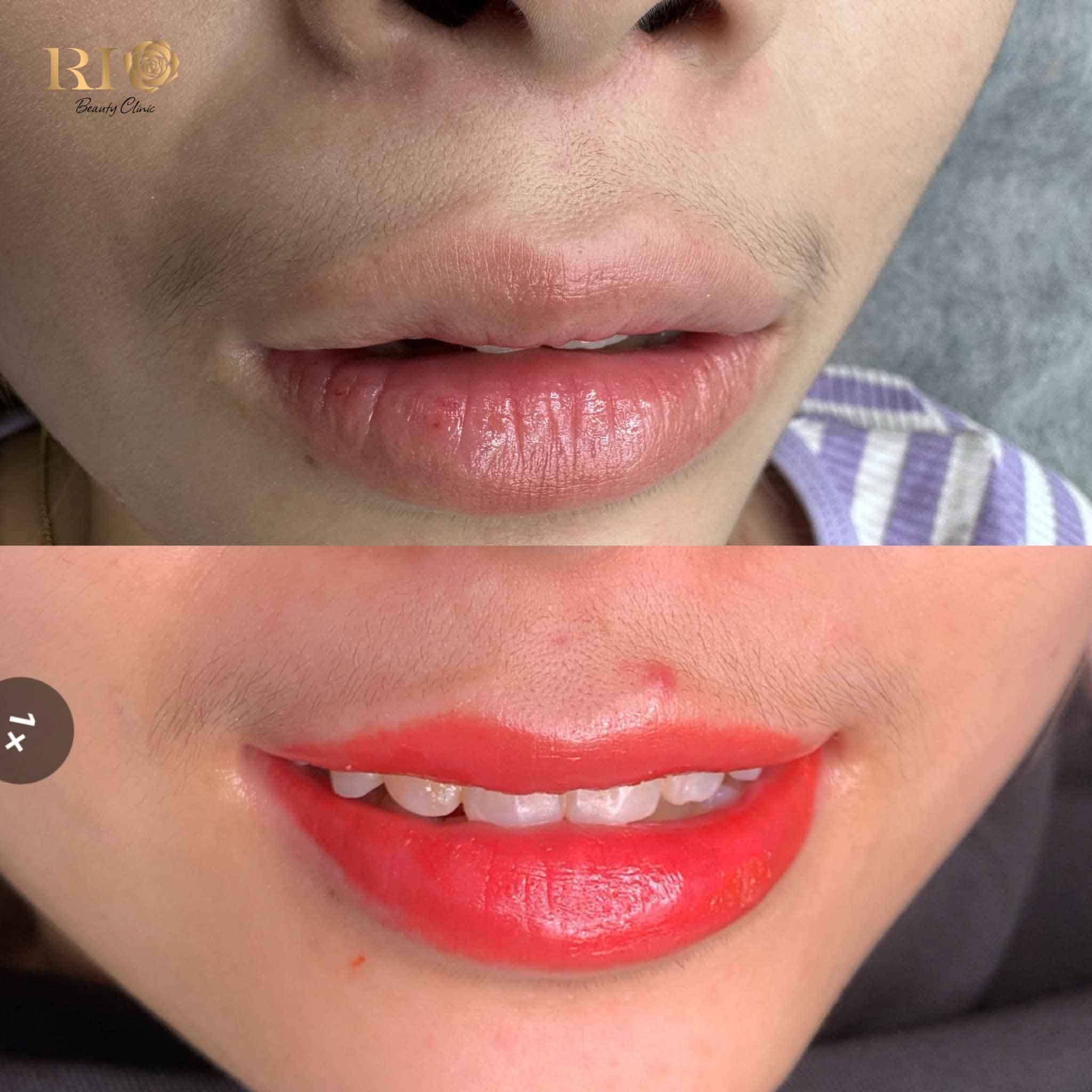 Màu môi hồng hào đẹp tự nhiên sau khi làm