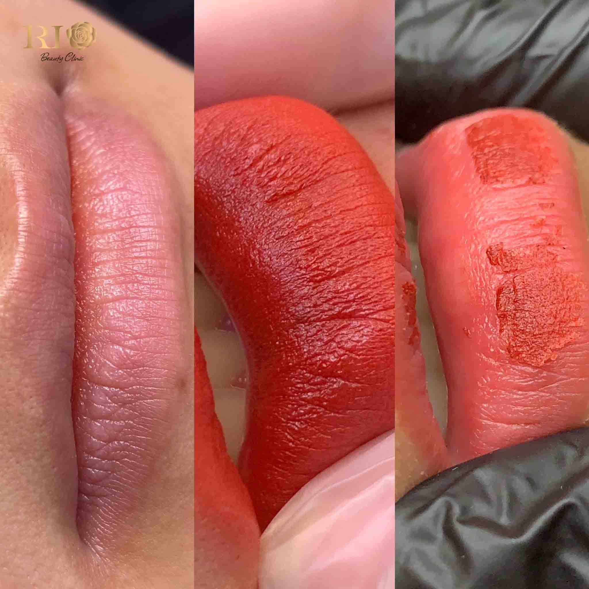 Màu môi khi đang trong thời gian bong tróc