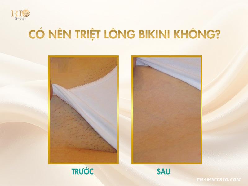 Có nên triệt lông bikini không? Giải đáp tất tần tật 4 Triệt lông bikini có tốt không?