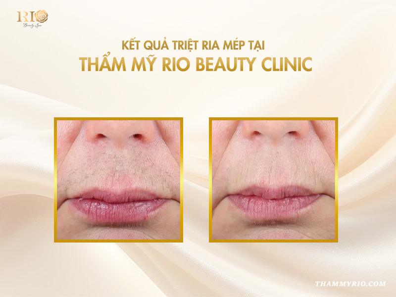 Giá triệt ria mép vĩnh viễn 2025: giá siêu hời, đẹp trọn đời 5 Giá triệt ria mép vĩnh viễn 2025: giá siêu hời, đẹp trọn đời