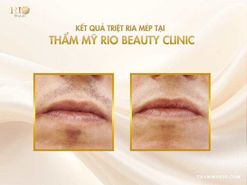Giá triệt ria mép vĩnh viễn 2025: giá siêu hời, đẹp trọn đời 7 Giá triệt ria mép vĩnh viễn 2025: giá siêu hời, đẹp trọn đời