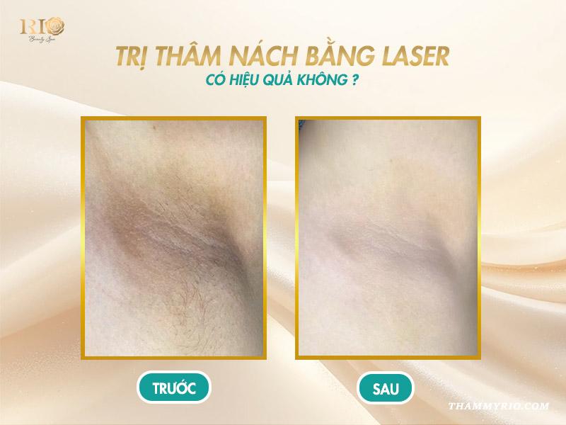 Giải pháp laser trị thâm nách an toàn, hiệu quả tại Thẩm mỹ Rio 4 Trị thâm nách bằng laser có hiệu quả không?