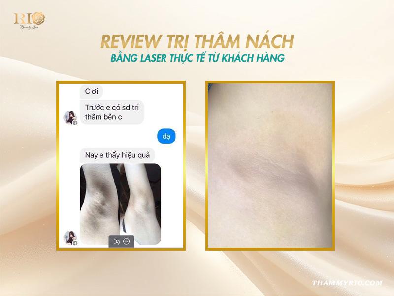 Giải pháp laser trị thâm nách an toàn, hiệu quả tại Thẩm mỹ Rio 7 Review trị thâm nách bằng laser thực tế từ khách hàng