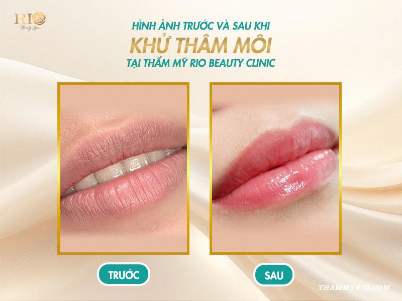 Khám phá cách chọn màu khử thâm môi chuẩn, xu hướng năm 2025 11 Khám phá cách chọn màu khử thâm môi chuẩn, xu hướng