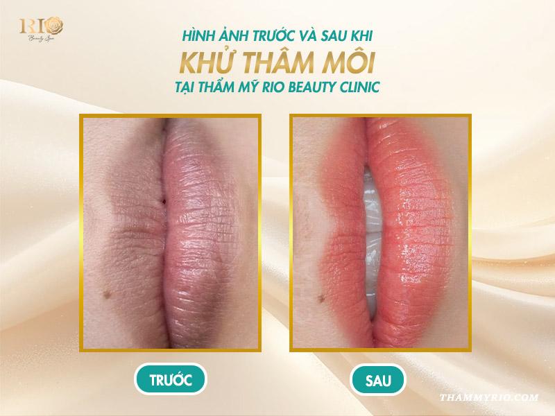 Khám phá cách chọn màu khử thâm môi chuẩn, xu hướng năm 2025 7 Khám phá cách chọn màu khử thâm môi chuẩn, xu hướng