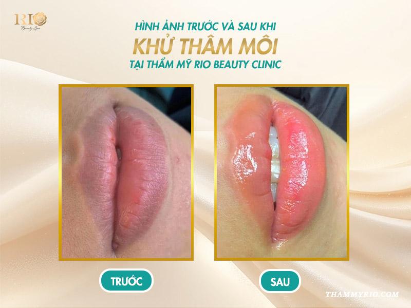 Khám phá cách chọn màu khử thâm môi chuẩn, xu hướng năm 2025 9 Khám phá cách chọn màu khử thâm môi chuẩn, xu hướng