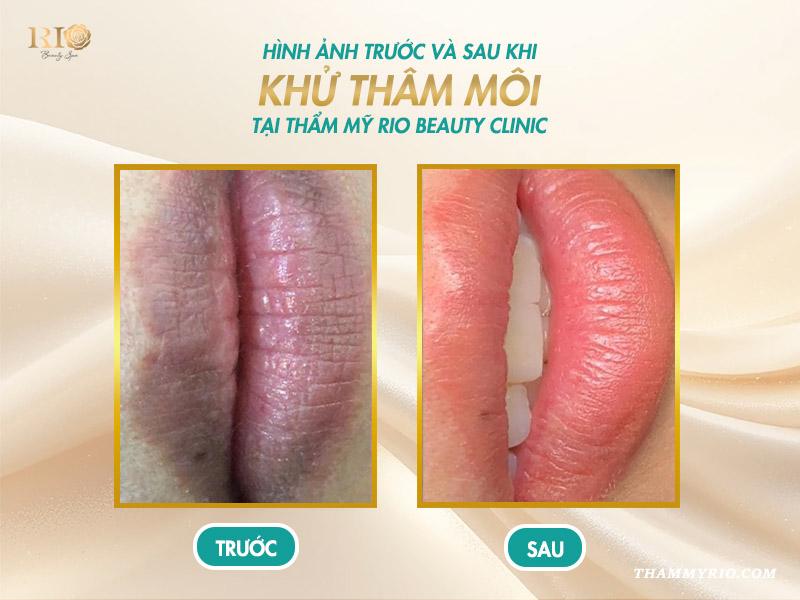 Khám phá cách chọn màu khử thâm môi chuẩn, xu hướng năm 2025 10 Khám phá cách chọn màu khử thâm môi chuẩn, xu hướng