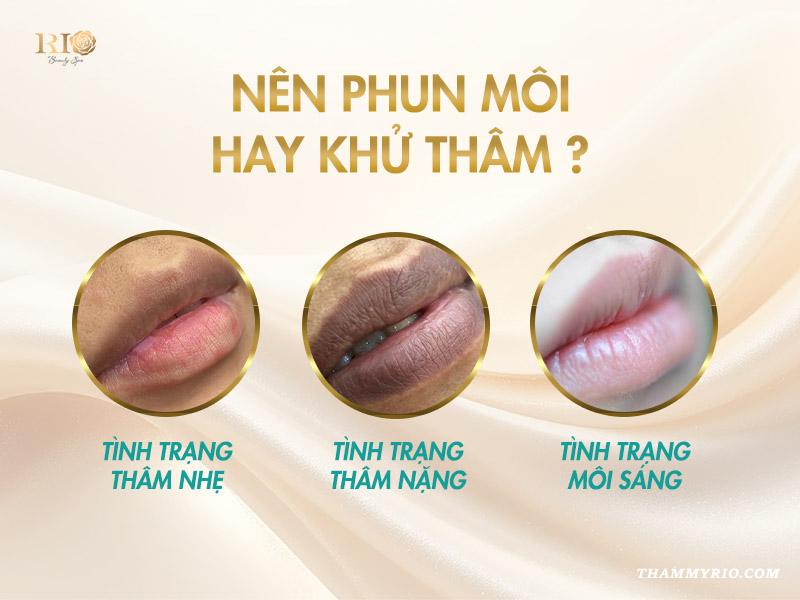 Nên khử thâm môi hay phun môi? Những điều bạn chưa biết 4 Nên phun môi hay khử thâm?