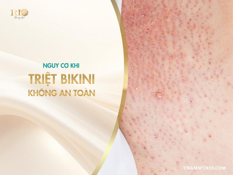 Triệt bikini mới nhất 2025 – an toàn, không đau 3 Nguy cơ khi triệt bikini không an toàn