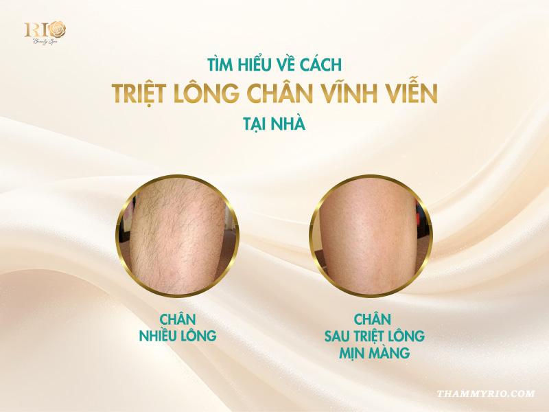 3 cách triệt lông chân vĩnh viễn tại nhà cho nữ siêu hot! 2 Tìm hiểu về cách triệt lông chân vĩnh viễn tại nhà