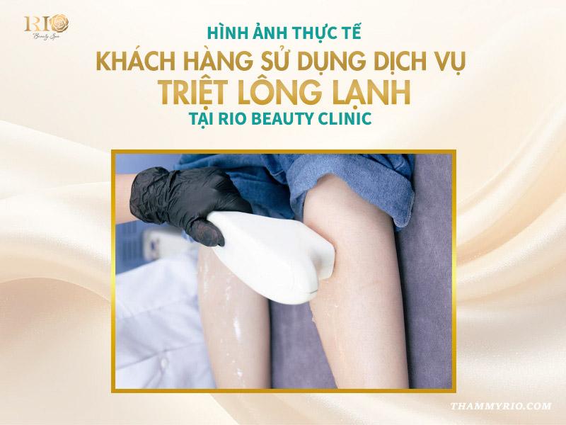 Công nghệ triệt lông lạnh an toàn mới nhất 2025 7 Hình ảnh thực tế khách hàng sử dụng dịch vụ triệt lông lạnh tại Rio Beauty Clinic