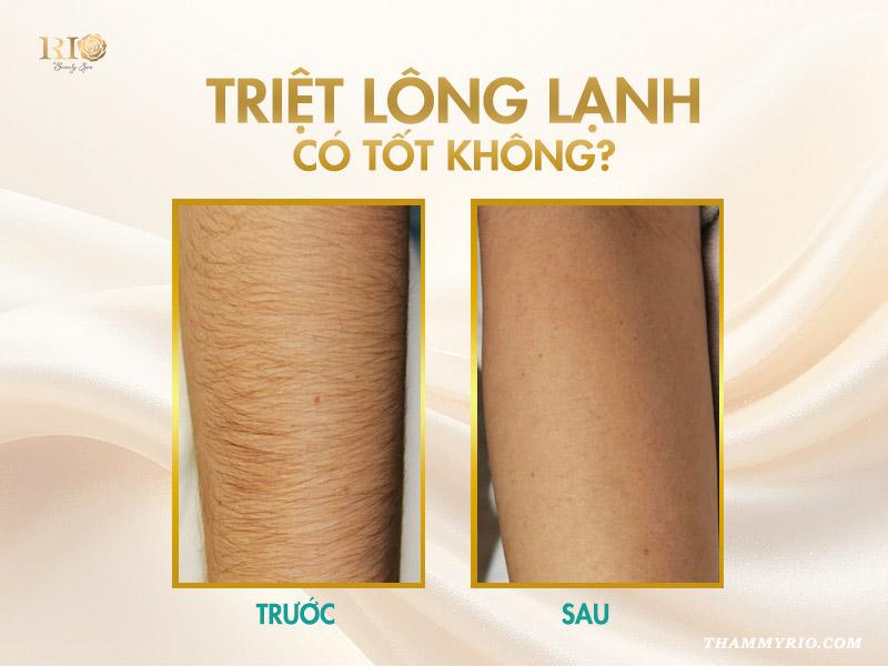 Công nghệ triệt lông lạnh an toàn mới nhất 2025 4 Triệt lông lạnh có tốt không?