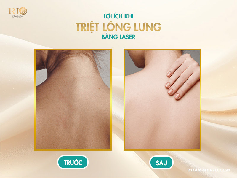 So sánh kết quả trước và sau khi triệt lông lưng bằng laser tại Rio Beauty Spa.