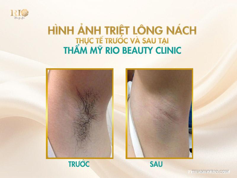 Triệt lông nách vĩnh viễn giá bao nhiêu? Cập nhật giá 2025 7 Hình ảnh triệt lông nách thực tế tại Thẩm mỹ Rio Beauty Clinic